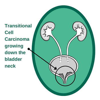 Transitional Cell Carcinoma